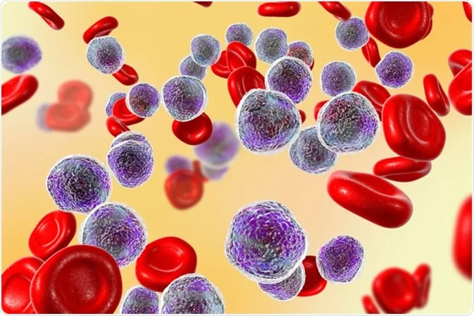 Six Symptoms of Leukemia That You Should Know About